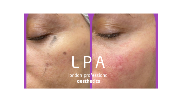 before and after mid-face lift using dermal filler