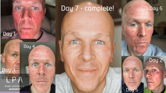 LPA client showing daily changes in his skin following The Perfect Peel