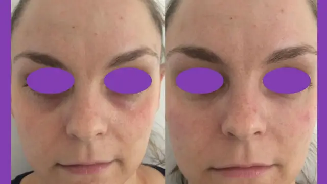 Before & after tear trough filler treatment