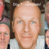 LPA client showing daily changes in his skin following The Perfect Peel